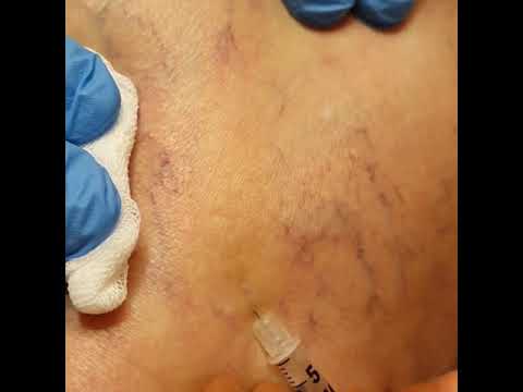 Microscleroterapi Scl 1